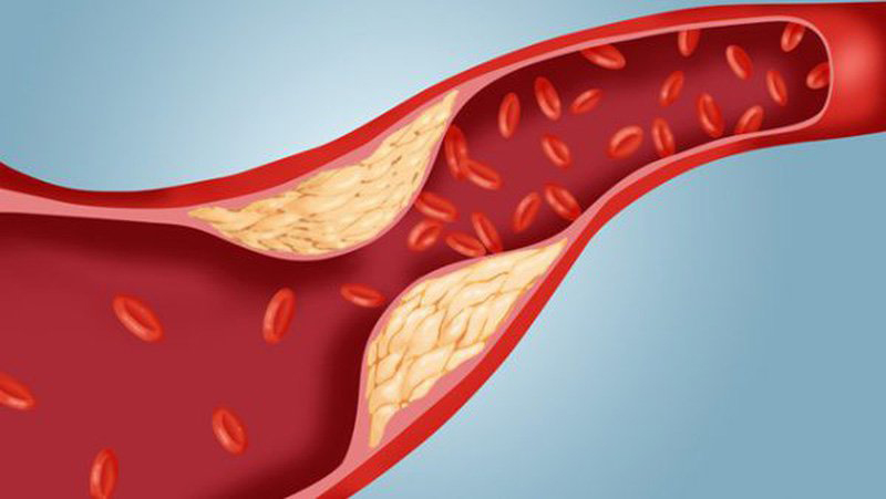 giảm lượng cholesterol từ mỡ trong máu